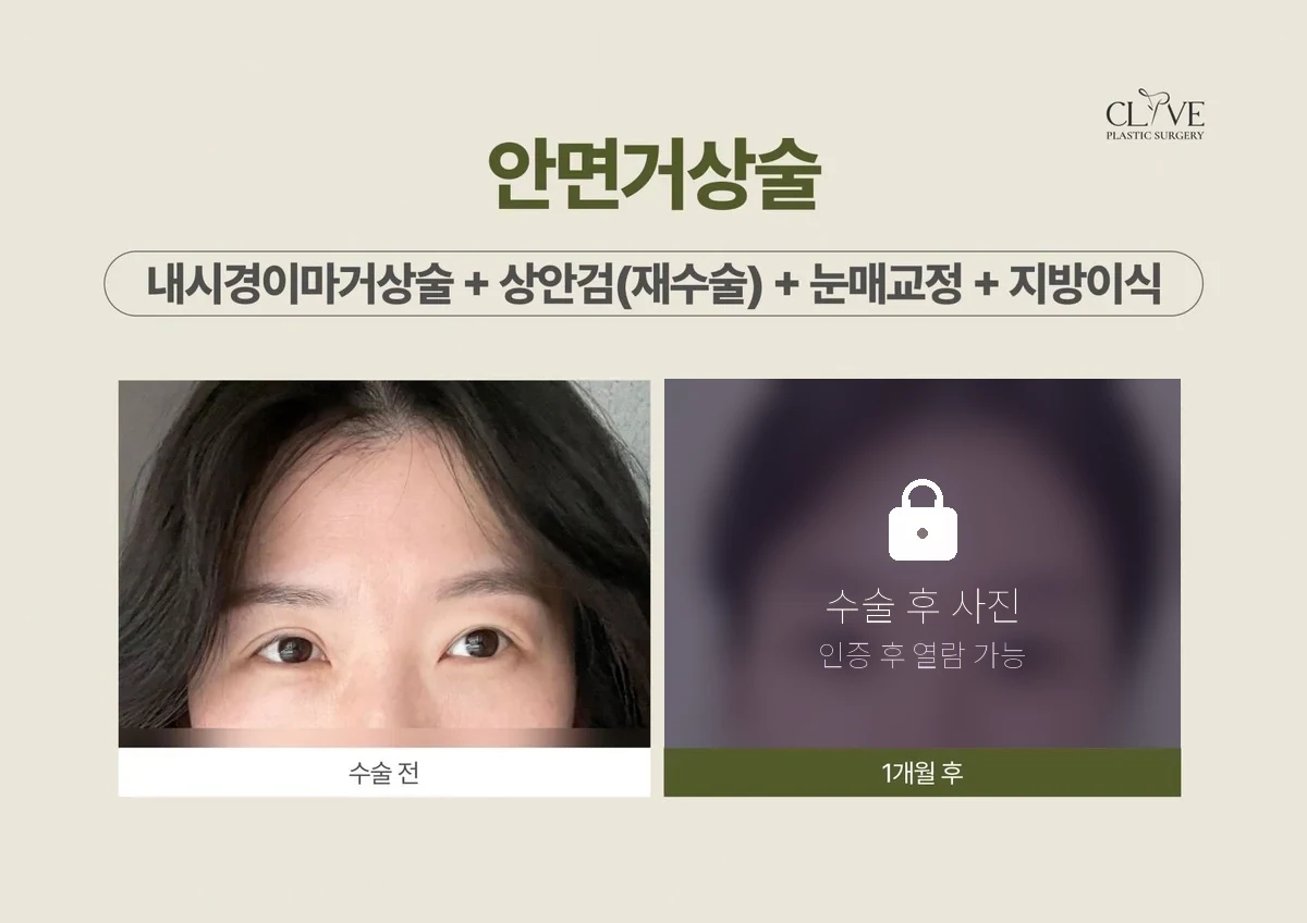 리프팅 내시경이마거상 + 상안검 재수술 + 눈매교정 전후