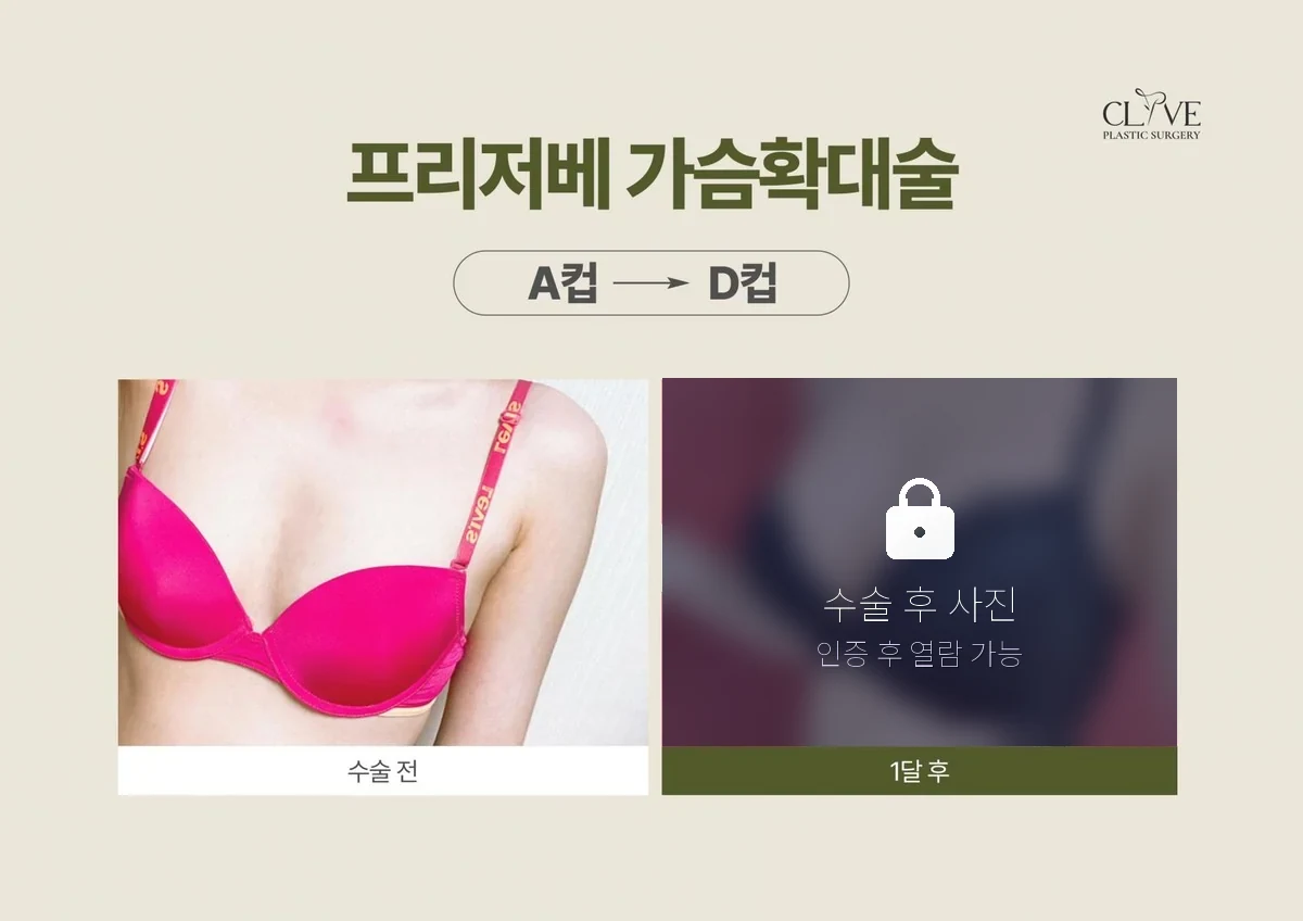 가슴성형 프리저베 가슴성형 전후