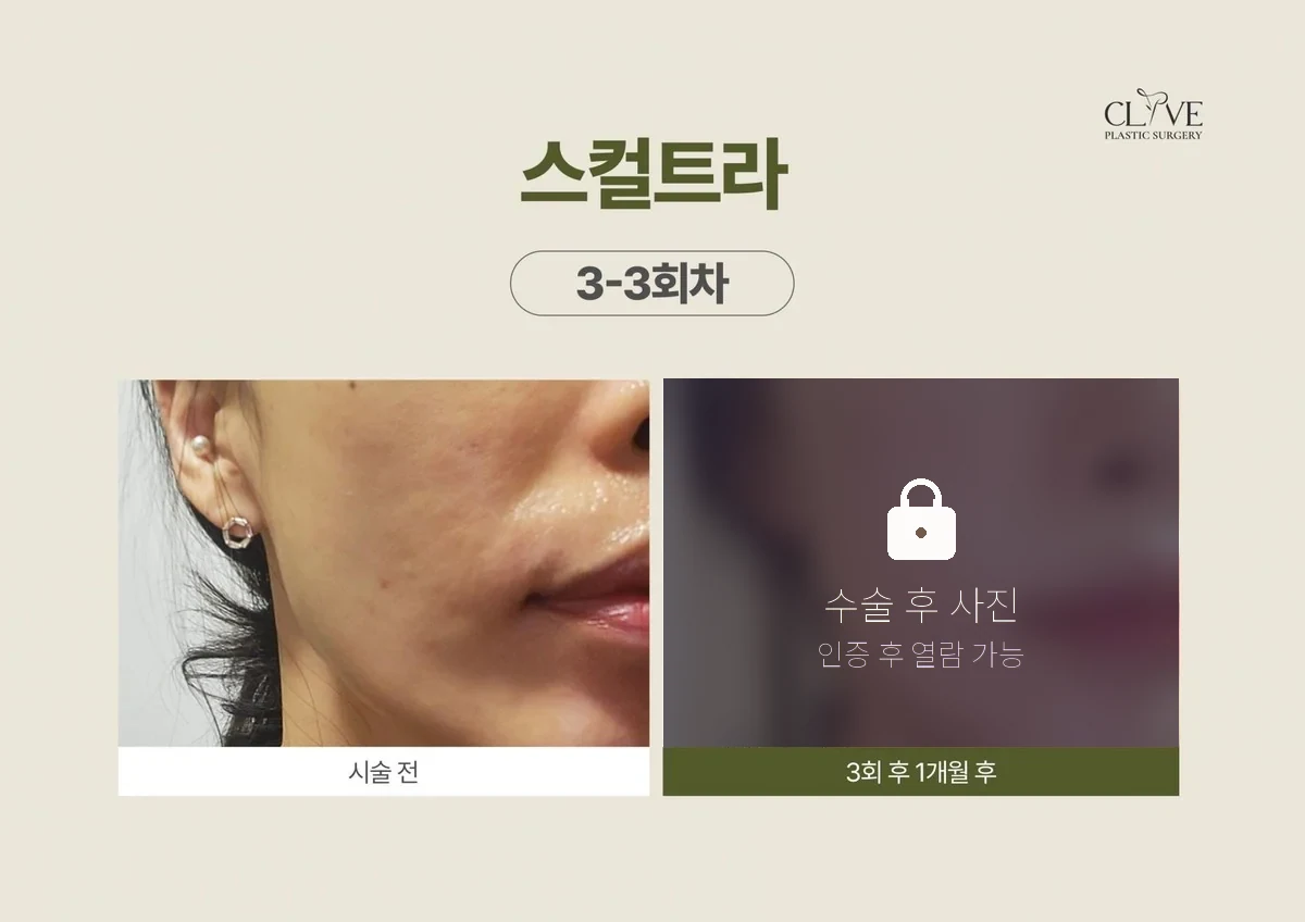 쁘띠시술 스컬트라 전후