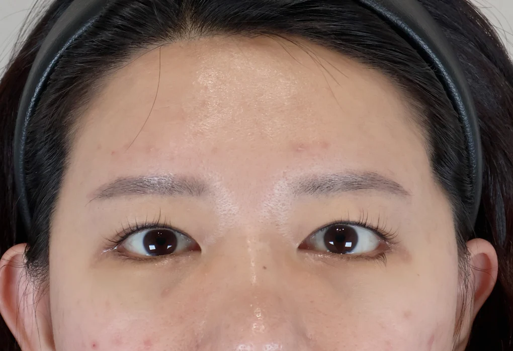 내시경 이마거상술 수술 전