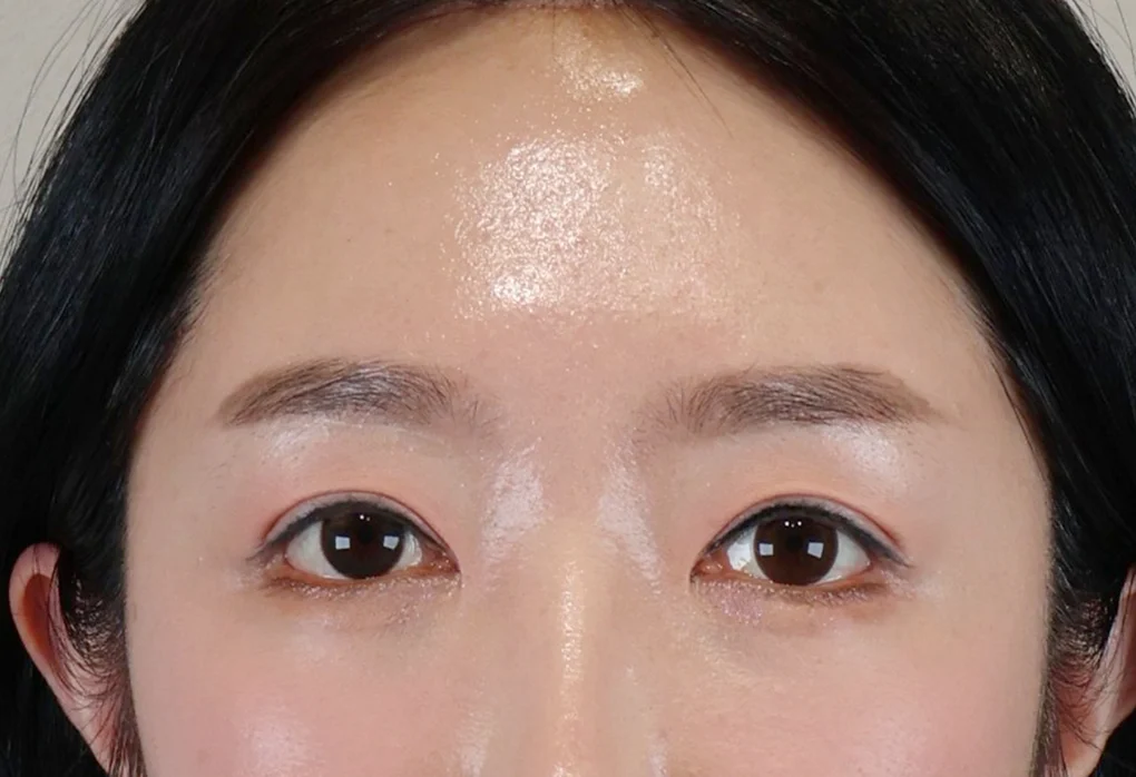내시경 이마거상술 수술 후