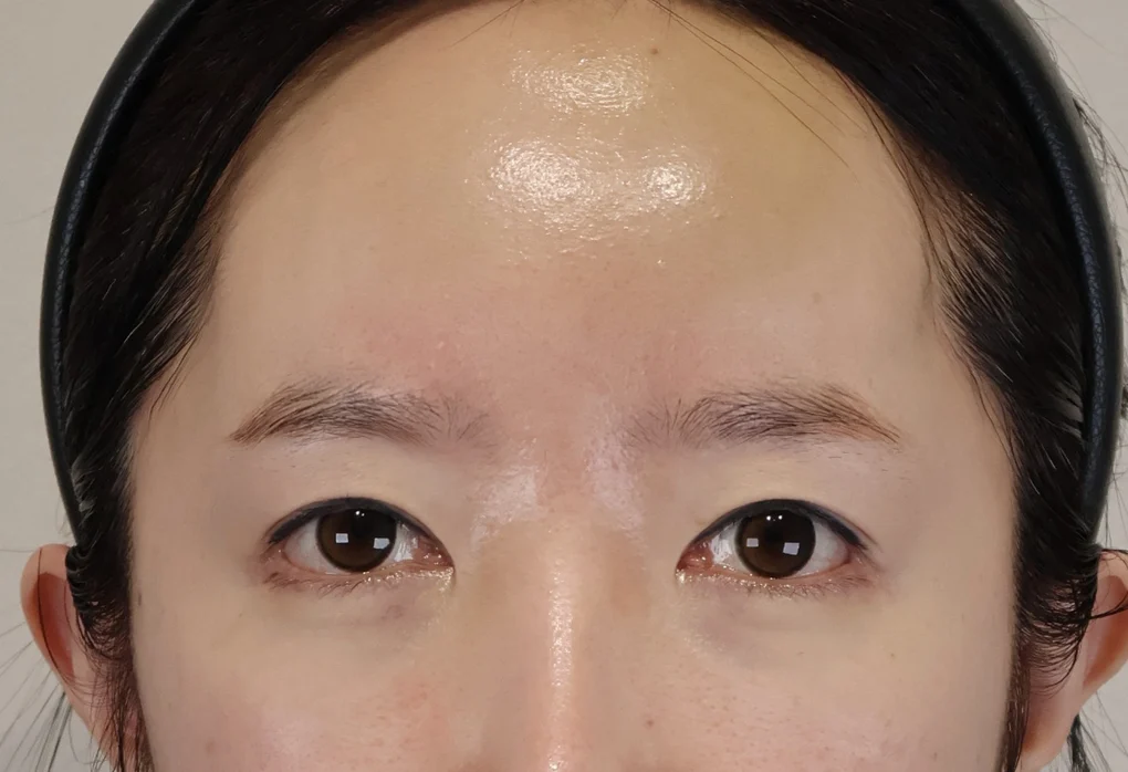 내시경 이마거상술 수술 전