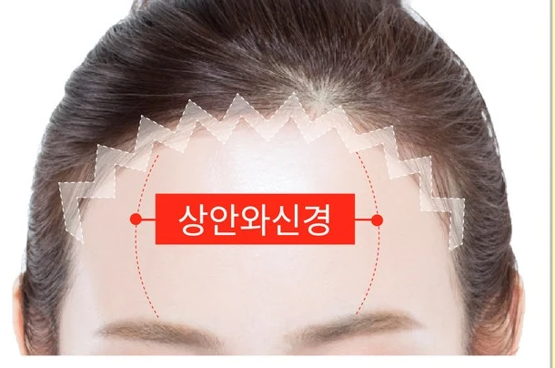 이마 조직 제거 — 상안와신경 보존