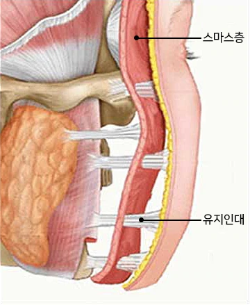 제대로 박리하지 않은 상태의 SMAS층과 유지인대 단면 도해